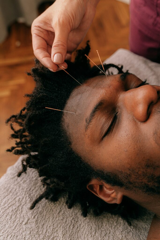 Close-up of acupuncture session with therapist inserting needles into a young man's forehead.